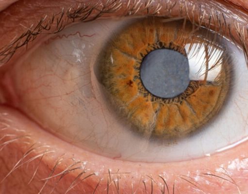 PT HEALTH WATCH: Delayed treatment of childhood cataracts can lead to irreversible vision loss – plateaureports